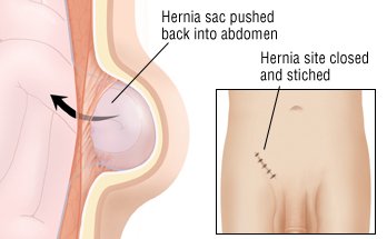 Hernia Size Chart