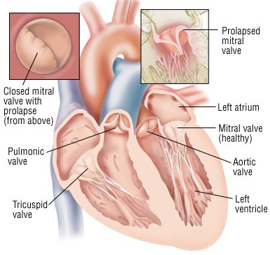 What are the symptoms of a leaky heart valve?