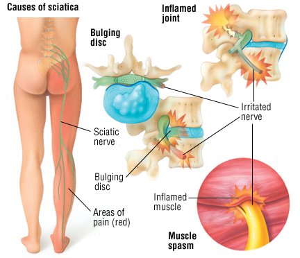 What are some symptoms of sciatica?