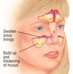 Pain Behind Eyes and Sinus Pressure - Treato