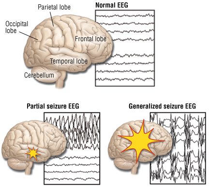 Seizure Diagram