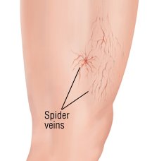 Spider Vein