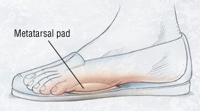 Corticosteroid injection feet