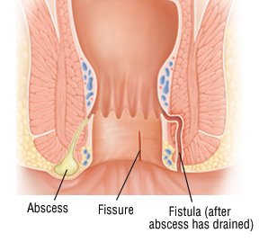 for fissure Benefiber anal