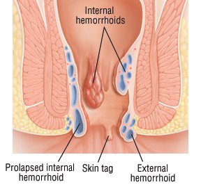 Pus near the anus