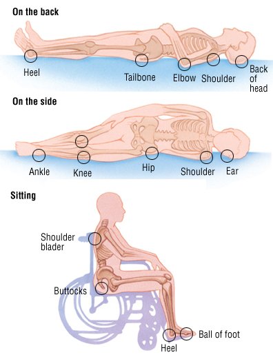 Bedsores Decubitus Ulcers Guide Causes Symptoms And Treatment Options