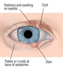 Αποτέλεσμα εικόνας για blepharitis symptoms