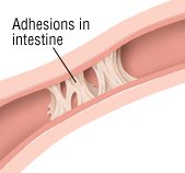 Bowel Obstruction