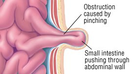 What are the symptoms of a ventral hernia?