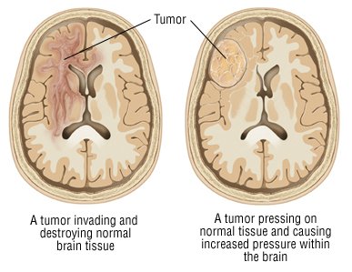 Benign Brain Tumor Size Chart