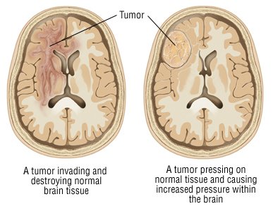 Can a fast-growing meningioma be benign?