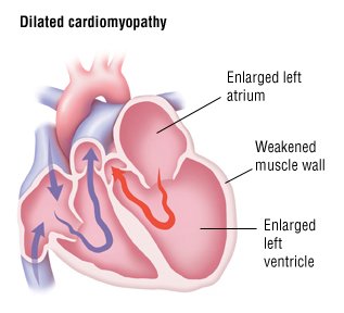 Cardiomyopathy Guide: Causes, Symptoms and Treatment Options
