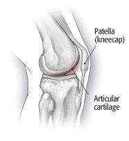 Chondromalacia patella