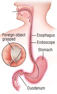 Accidentally Swallow Glass image Accidentally Swallow Glass photo