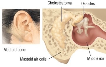 What causes fluid in mastoid cells?