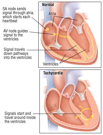 What causes a high heart rate?