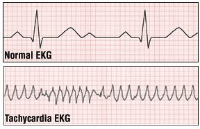 What are some treatments for a rapid heartbeat?