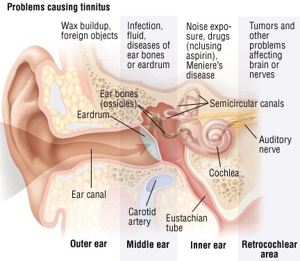 How can you stop the ringing caused by tinnitus?
