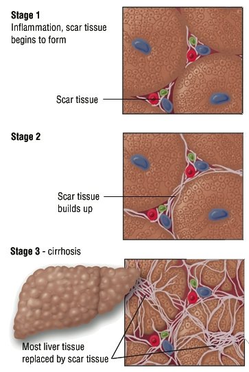 What are some treatment options for cirrhosis?