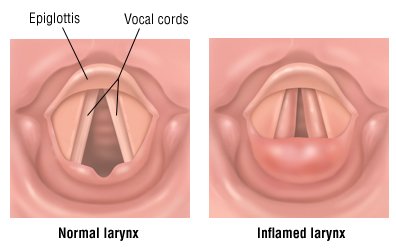 Chronic Laryngitis