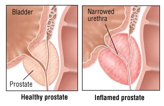 Prostatitis edény kezelése)