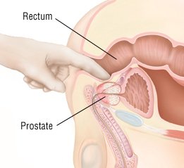 Krónikus számú prostatitis DGPZH