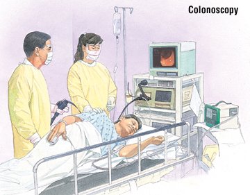 What are the symptoms of colitis?