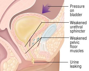 Do the symptoms of a women's bladder infection include a strong urge to urinate?