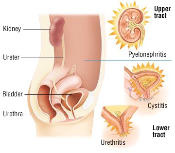 Do the symptoms of a women's bladder infection include a strong urge to urinate?