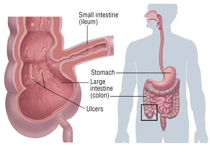 Crohn s Disease And Disease