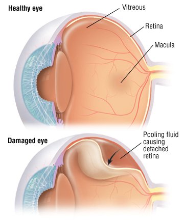 In the United States, retinal detachment is a relatively uncommon