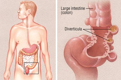 What are the symptoms of signmoid diverticulosis?