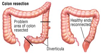 What are the symptoms of signmoid diverticulosis?