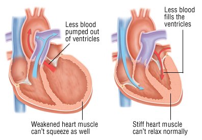 Are there any side effects associated with treatment of fluid around the heart?