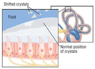 vertigo ear vestibular neuritis exercises crystals inner causes dizziness balance labyrinthitis treatment guide head drugs symptoms does faqs frequently asked