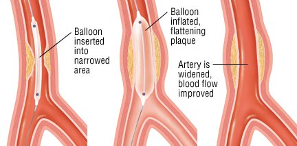 angioplasty guide drugs com