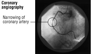 Cardiac Catheterization