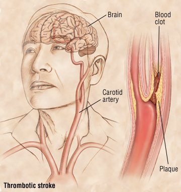 What could cause a stroke in the brain?