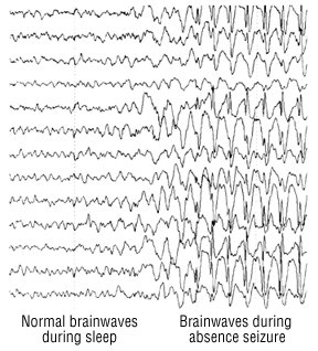 Nongenetic Pathologic Developments of Brain-Wave Patterns