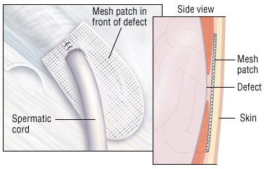 What are symptoms of problems with the mesh used in hernia surgery?