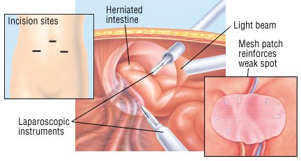 herniorrhaphy