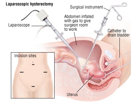Intercourse After Laparoscopic Surgery 94