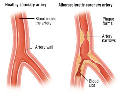 Angina Guide: Causes, Symptoms and Treatment Options