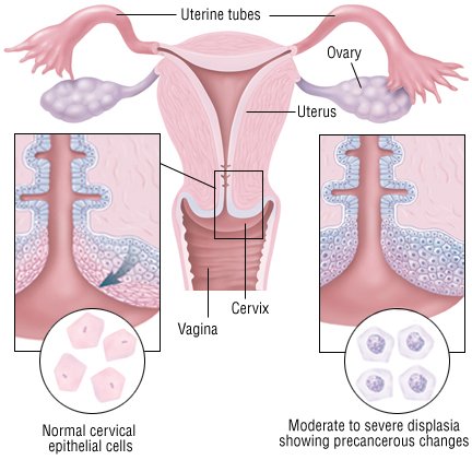 case study abnormal pap smear