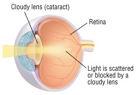 What causes cataracts?