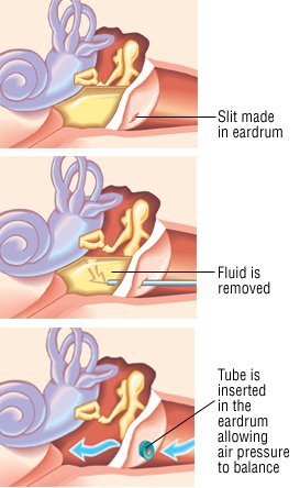 What are the causes of earaches?