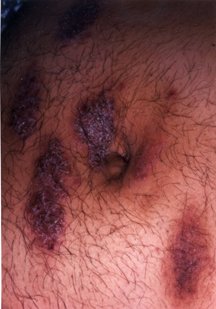 Rashes | Associates In Dermatology