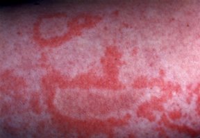 Hives (Urticaria)