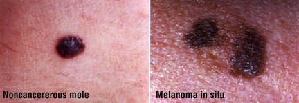 Skin Cancer Symptoms: Pictures of Skin Cancer and ...