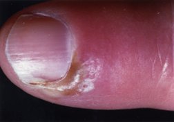 Paronychia (nail infection ) - WebMD Boots